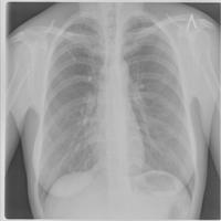 CXR TB or Normal project thumbnail