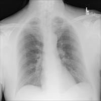 Chest Xrays project thumbnail