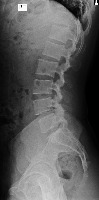 Vertebras  project thumbnail