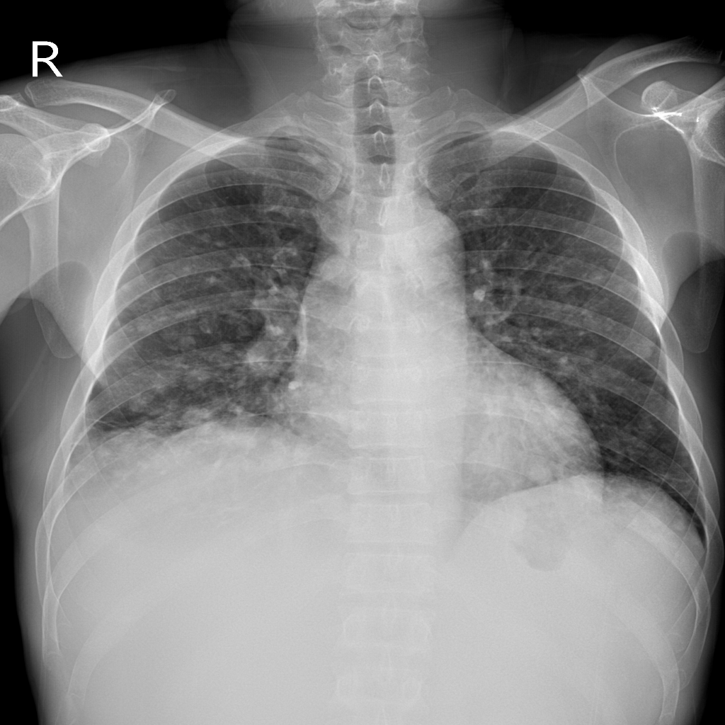 lung Object Detection Dataset by repk1124