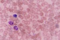 Hypersegmentation Neutrophil project thumbnail