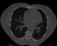 lung project thumbnail