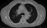 lung cancer detection project thumbnail