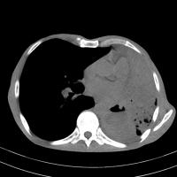 Chest Disease Detection project thumbnail