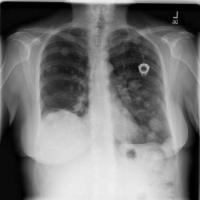 lung project thumbnail