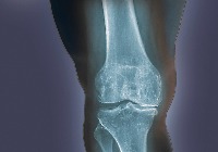 bone project thumbnail