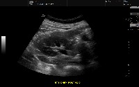 Ultrasound Normal KIdney Image  project thumbnail