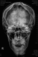 seno-frontal-caldwell project thumbnail