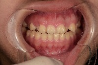 detection gingivitis project thumbnail