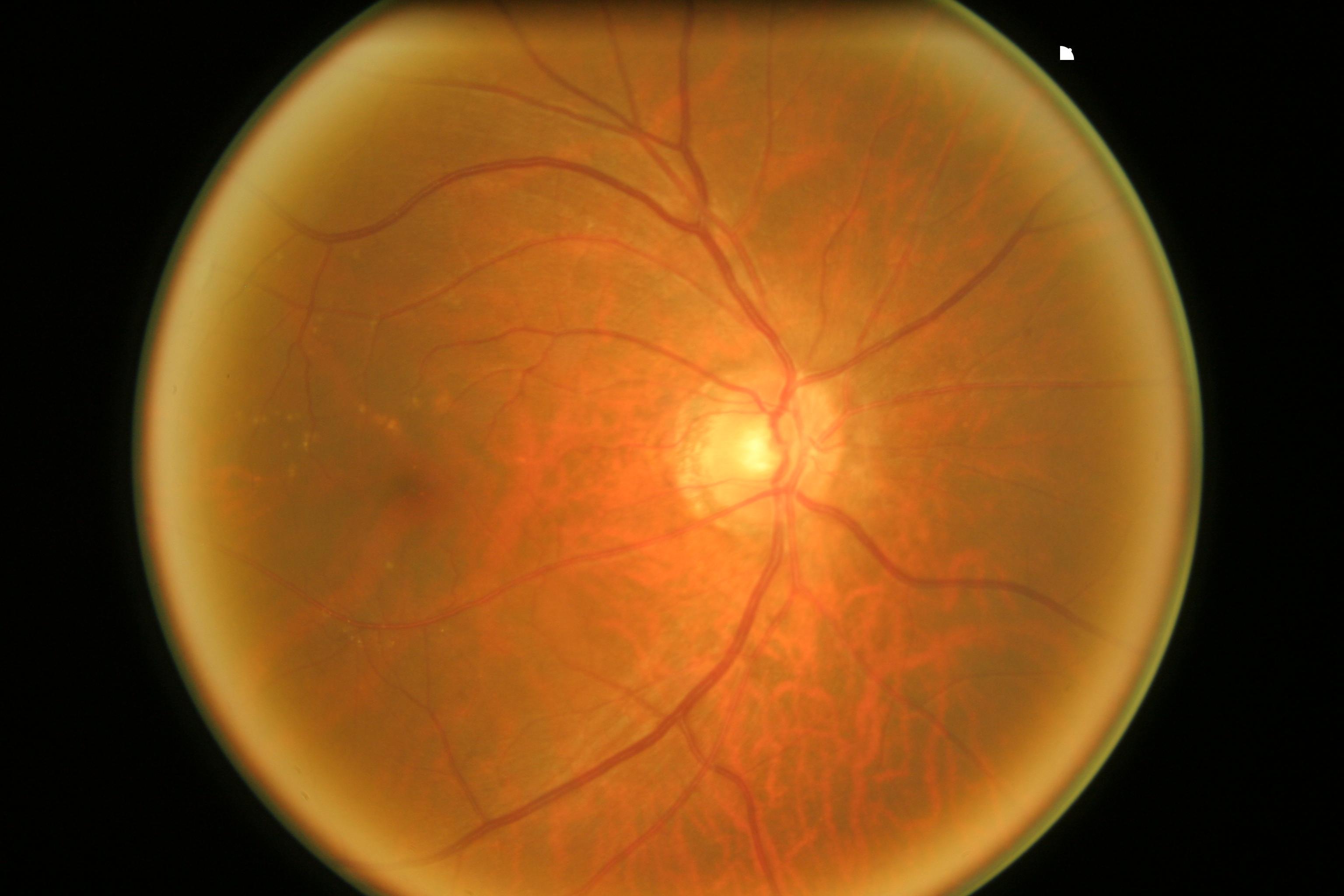 Glaucoma Model 2 Object Detection Dataset by Cataract glaucom