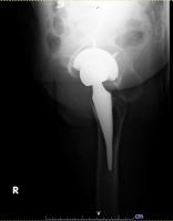 Hip_Stem_type-seg project thumbnail