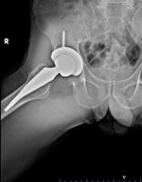 Hip_Stem_type project thumbnail