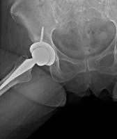 Hip_cup_type-seg project thumbnail