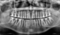 Dental OPG project thumbnail