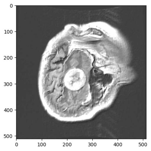 Glioblastoma Early Diagnosis Instance Segmentation Dataset and Pre
