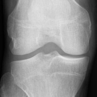 Knee Osteoarthritis Dataset Object Detection Model by tru projects