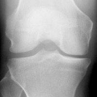 Knee Osteoarthritis Dataset Object Detection Model by tru projects