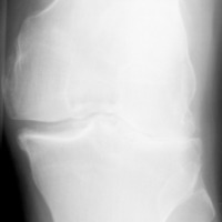 Knee Osteoarthritis Dataset Object Detection Dataset and Pre-Trained ...