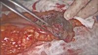 surgical video #2 project thumbnail