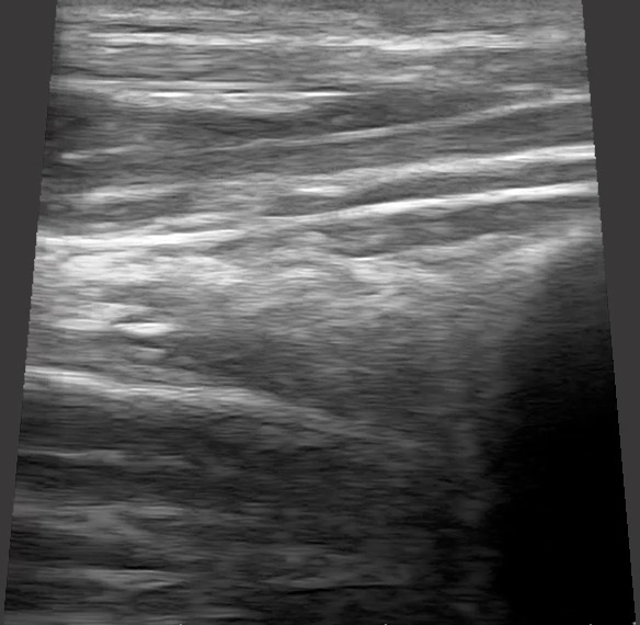 Longitudinal view Instance Segmentation Dataset by Surgical AI