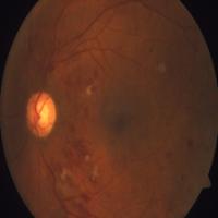 diabetic_retinopathy_images_Eshansd project thumbnail