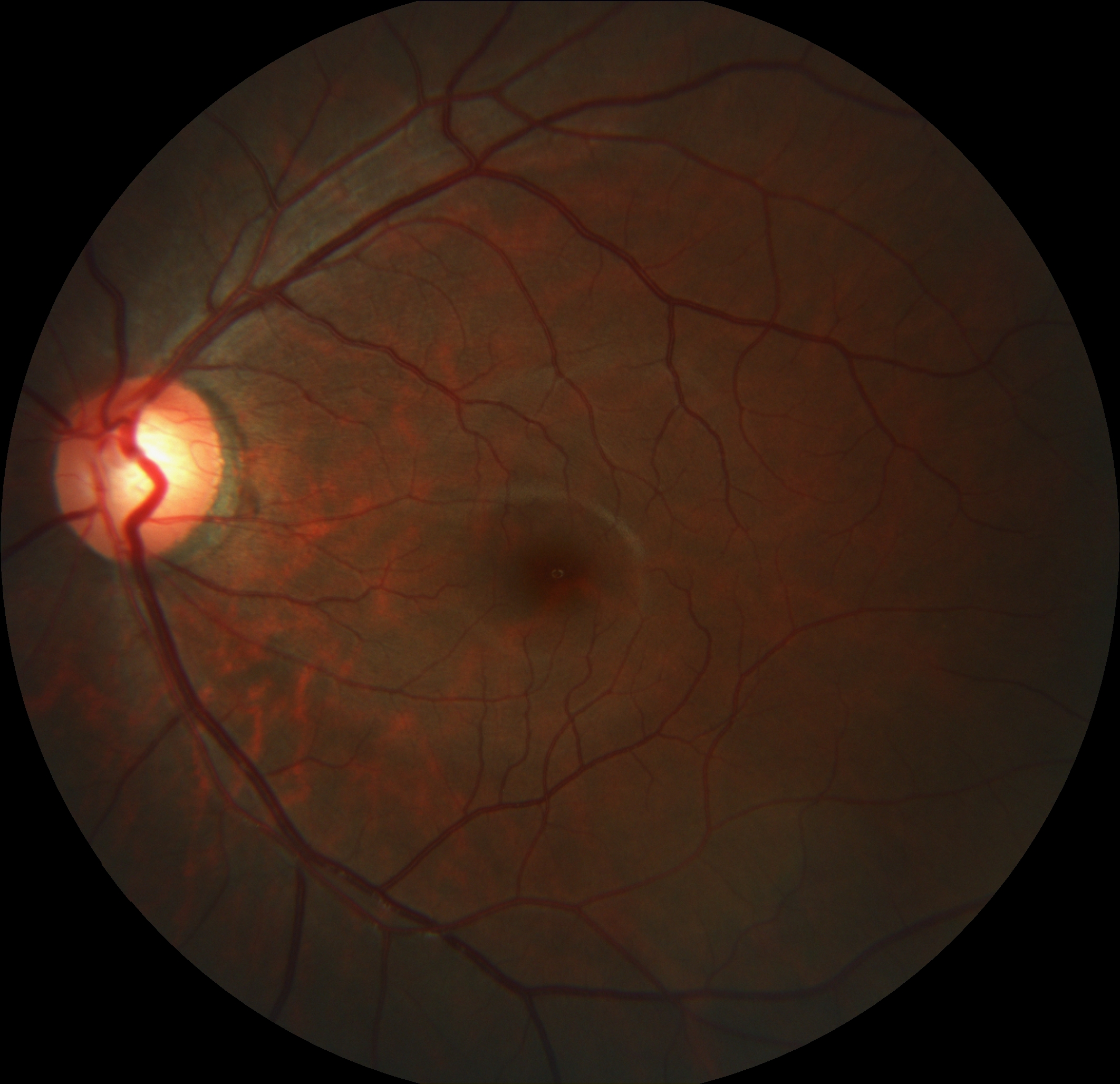 Optic Disc Detection Object Detection Model by Siddhartha Mallick