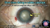 S_CC_2370_first white cataract project thumbnail