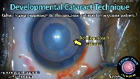 S_CC_2356_developmental cataract project thumbnail