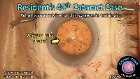 S_CC_2273 40th cataract project thumbnail