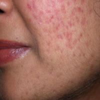 Skin-Detection project thumbnail