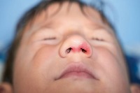 Impetigo project thumbnail