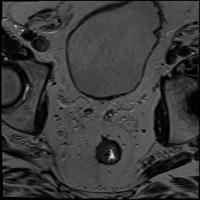 Prostate Detection project thumbnail
