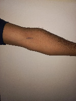 Vein Detection project thumbnail