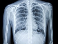LUNG CANCER project thumbnail