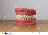 teeth cavity detector  project thumbnail
