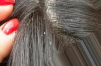 Hair Disease project thumbnail