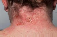 Scalp Disease project thumbnail