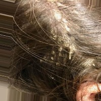 HAIR_AND_SCALP_DISEASE  project thumbnail
