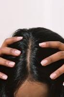 psoriasis-normal scalp project thumbnail