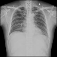 Lungs project thumbnail
