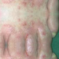 notscabies project thumbnail