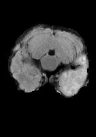 Glioma Binary Classification  project thumbnail