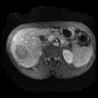 Liver Tumor_2 project thumbnail