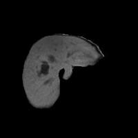 Liver Tumor_ROI project thumbnail