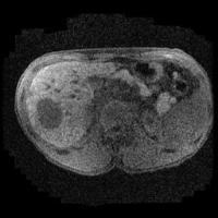 Liver Tumor_400 project thumbnail