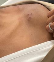 atopic_dermatitis 201 - 500 project thumbnail