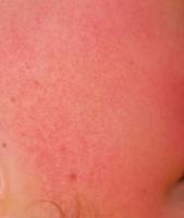 keratosis_pilaris project thumbnail