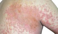 atopic derm3 img project thumbnail