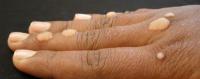 warts_annotate project thumbnail