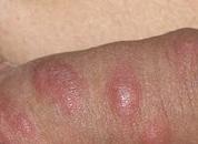 scabies project thumbnail